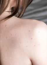 Causes of Chest Acne & Bacne (Back Acne) and How to Treat These Breakouts