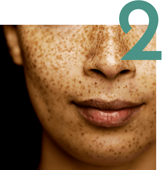 A woman’s face with spots