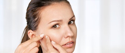 How To Treat Acne Breakouts With Salicylic Acid 