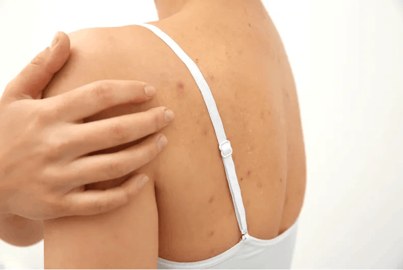 Acné en la espalda: causas, tratamientos y prevención