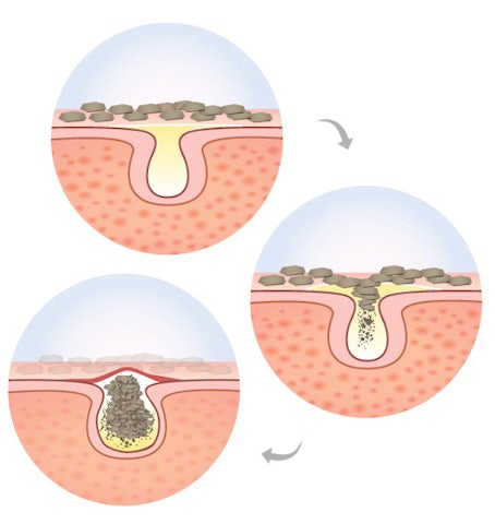 Common Causes of Acne: All About Acne Part II | The Bar