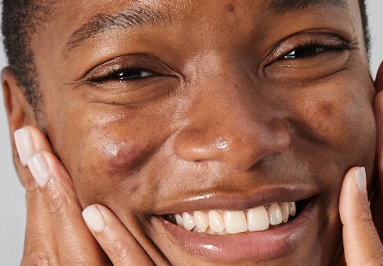 A woman with acne on her face, beaming with a smile.