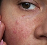 Cómo elegir el mejor limpiador facial para piel sensible
