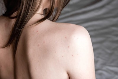 Back & Chest Acne  Causes, Tips & How To Get Rid of Back Acne - UpCircle  Beauty