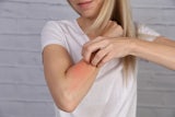 ¿Pueden las alergias estacionales afectar tu piel? Conoce cómo tratar los síntomas de la alergia de la piel en verano