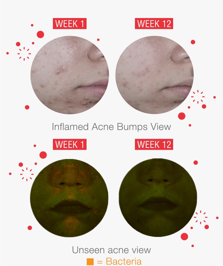 Neutrogena Acne Scar Treatment - Captions Beautiful